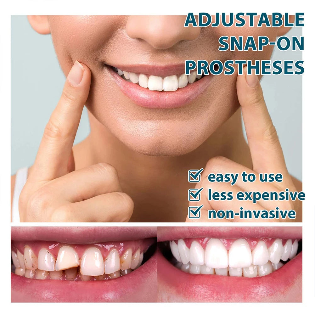 Instant Smile Veneers